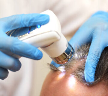 Trichoscopy is a computer examination of the scalp and hair. A cosmetologist-trichologist diagnoses the condition of a male patient's hair with gray hair using a trichoscope.